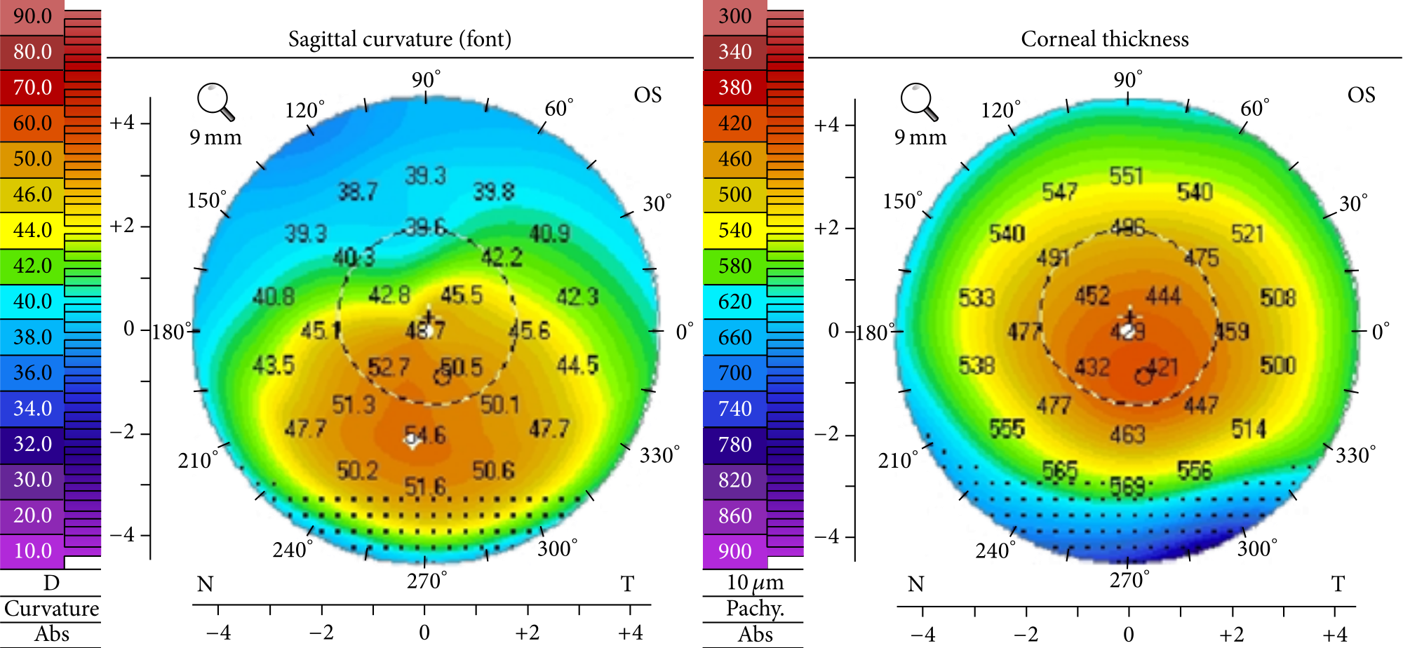 What To Know About Corneal Topography – Part 1 - Living With Keratoconus